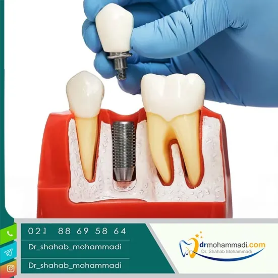راهکارهای پرداخت اقساطی یا بیمه برای کاهش هزینه ایمپلنت
